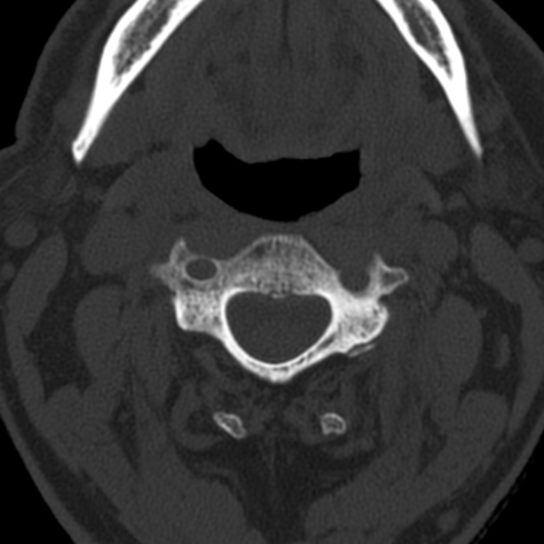 Anterior cervical postdiscectomy arthrodesis (Radiopaedia 32678-33646 Axial bone window 27).jpg