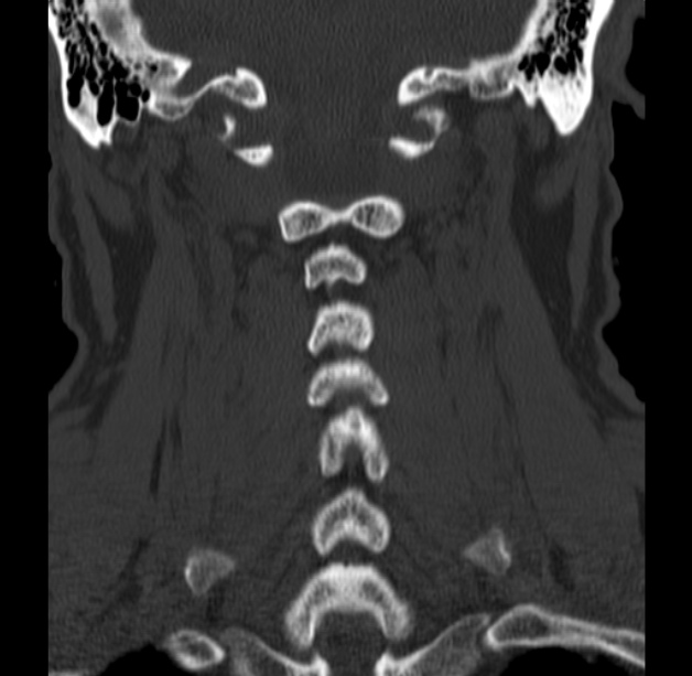 Anterior cervical postdiscectomy arthrodesis (Radiopaedia 32678-33646 Coronal bone window 46).jpg