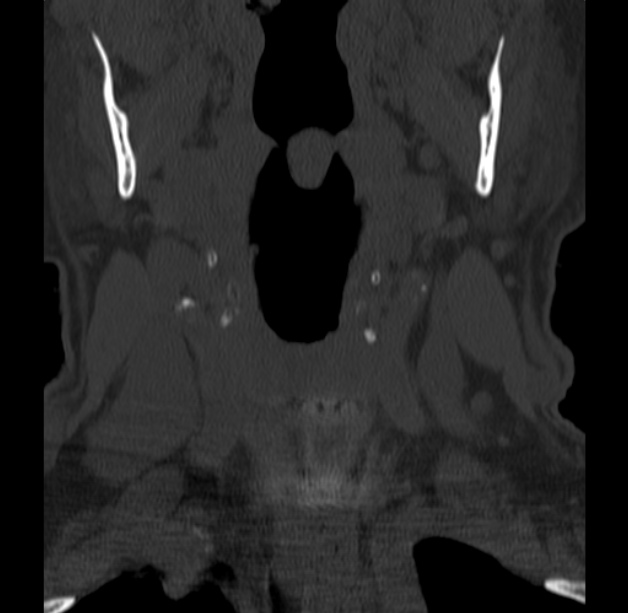 Anterior cervical postdiscectomy arthrodesis (Radiopaedia 32678-33646 Coronal bone window 5).jpg