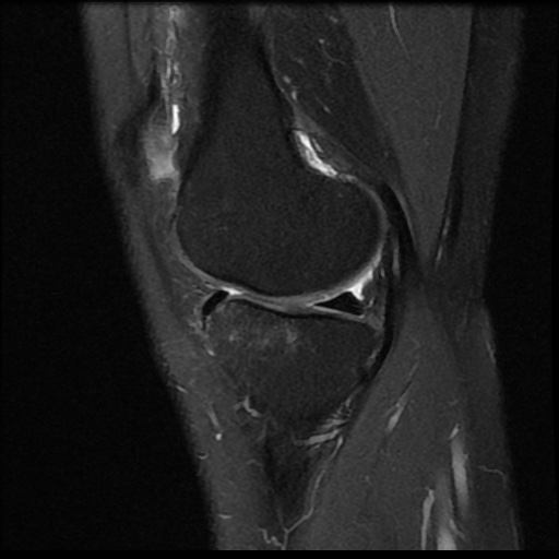 File:Anterior cruciate ligament avulsion fracture (Radiopaedia 58939-66193 Sagittal PD fat sat 15).jpg
