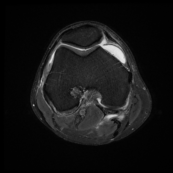 File:Anterior cruciate ligament graft tear and bucket-handle tear of medial meniscus (Radiopaedia 75867-87255 Axial PD fat sat 14).jpg