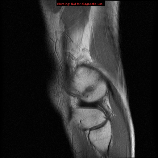 File:Anterior cruciate ligament injury - partial thickness tear (Radiopaedia 12176-12515 Sagittal PD 17).jpg
