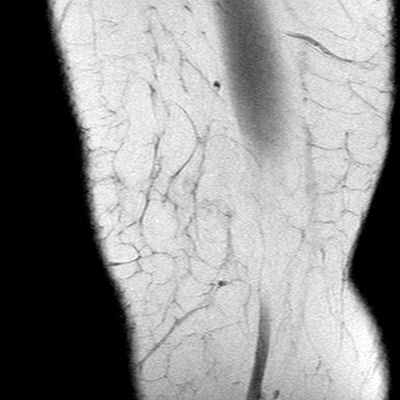 Anterior cruciate ligament mucoid degeneration (Radiopaedia 60853-68633 Sagittal T1 1).jpg