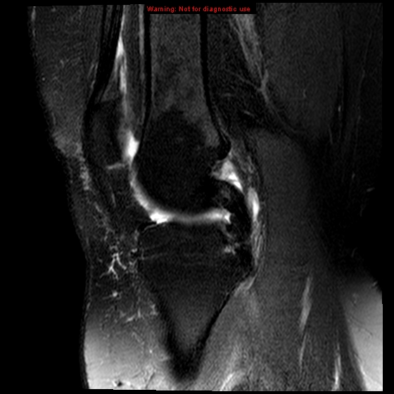 File:Anterior cruciate ligament tear (Radiopaedia 12329-12612 E 13).jpg