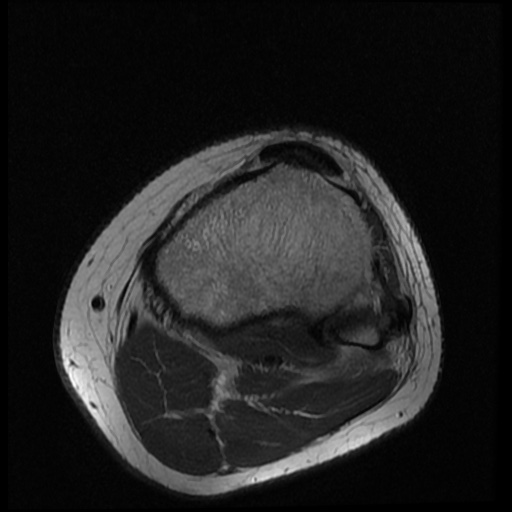 File:Anterior cruciate ligament tear (Radiopaedia 61500-69462 Axial PD 20).jpg