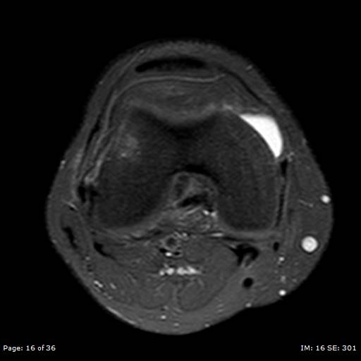 File:Anterior cruciate ligament tear (Radiopaedia 70783-80964 Axial PD fat sat 16).jpg