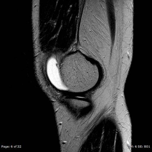 File:Anterior cruciate ligament tear (Radiopaedia 70783-80964 Sagittal T2 6).jpg