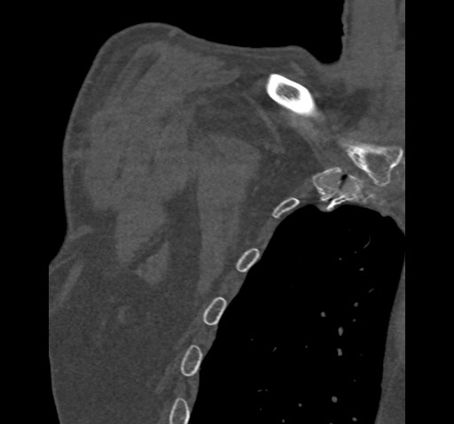 Anterior glenohumeral dislocation with Hill-Sachs lesion (Radiopaedia 62877-71249 Coronal bone window 5).jpg
