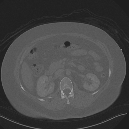Anterior superior iliac spine avulsion fracture (Radiopaedia 44541-48244 Axial bone window 39).png