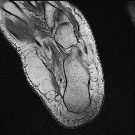 File:Anterior talofibular ligament injury - rupture with soft-tissue impingement (Radiopaedia 38765-40928 Axial PD 32).jpg