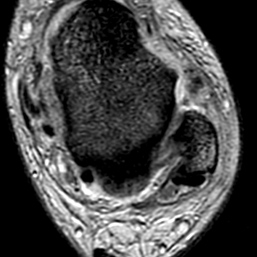 File:Anterior talofibular ligament rupture (Radiopaedia 15831-15484 Axial T2* 11).jpg