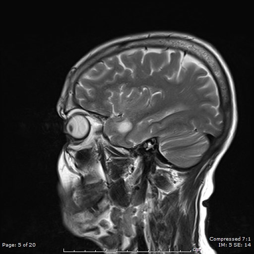 File:Anterior temporal lobe perivascular space (Radiopaedia 88283-104914 Sagittal T2 5).jpg