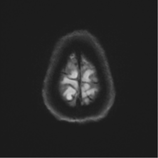 Anterior temporal pole cysts (Radiopaedia 46629-51102 Axial DWI 53).png