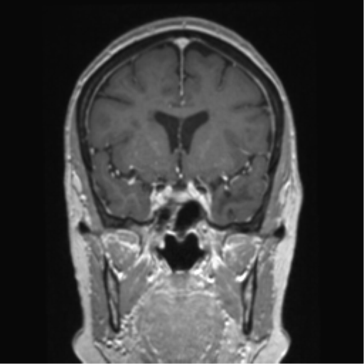 Anterior temporal pole cysts (Radiopaedia 46629-51102 Coronal T1 C+ 109).png