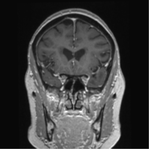 Anterior temporal pole cysts (Radiopaedia 46629-51102 Coronal T1 C+ 118).png