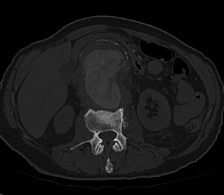 File:Anterior vertebral scalloping (abdominal aortic aneurysm) (Radiopaedia 66744-76067 Axial bone window 8).jpg