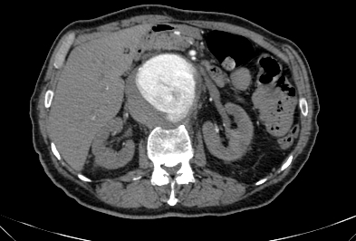 File:Anterior vertebral scalloping (abdominal aortic aneurysm) (Radiopaedia 66744-76067 F 22).jpg