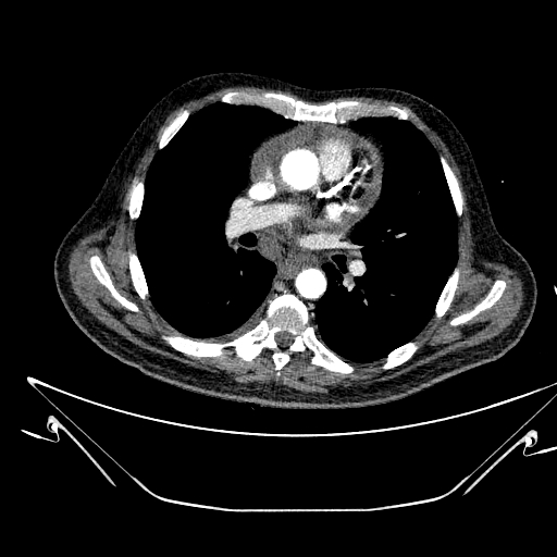 Aortic arch aneurysm (Radiopaedia 84109-99365 B 314).jpg