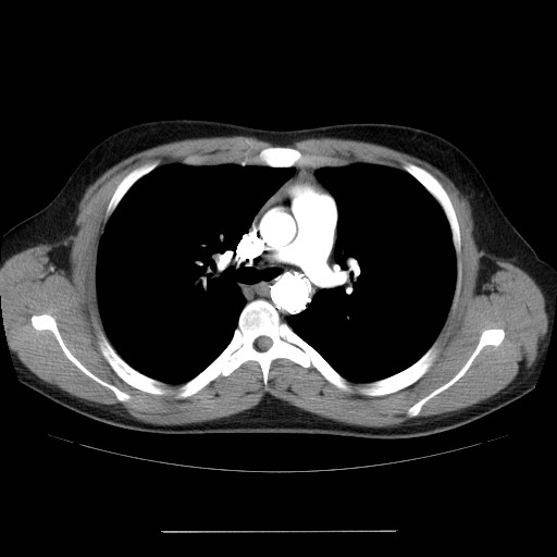 File:Aortic arch stent (Radiopaedia 30030-30595 D 14).jpg