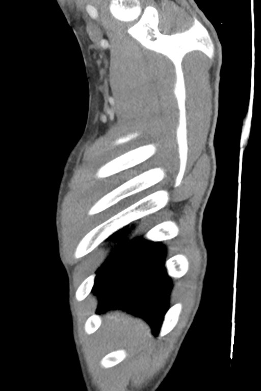 Aortic coarctation with aneurysm (Radiopaedia 74818-85828 B 18).jpg
