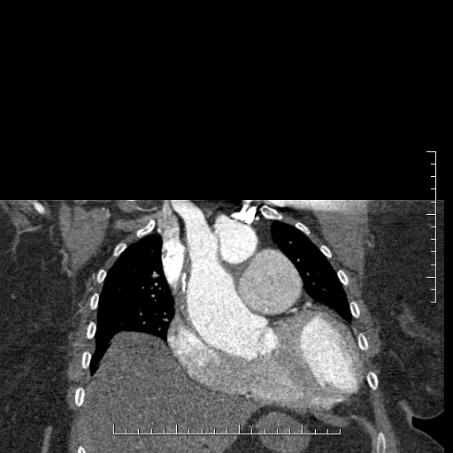 File:Aortic dissection- Stanford A (Radiopaedia 35729-37268 E 47).jpg