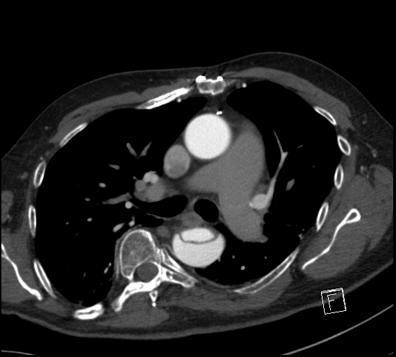 Aortic dissection (CTPA) (Radiopaedia 75506-86750 A 41).jpg