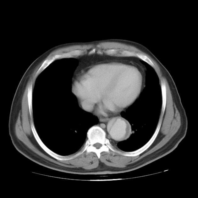Aortic dissection (Radiopaedia 44411-48061 C 64).jpg