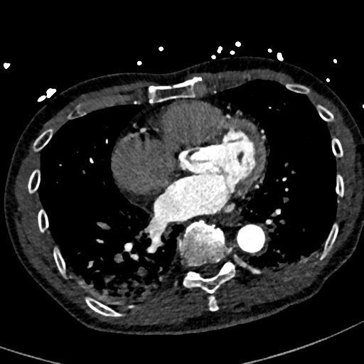 Aortic dissection - DeBakey type II (Radiopaedia 64302-73082 A 59).png