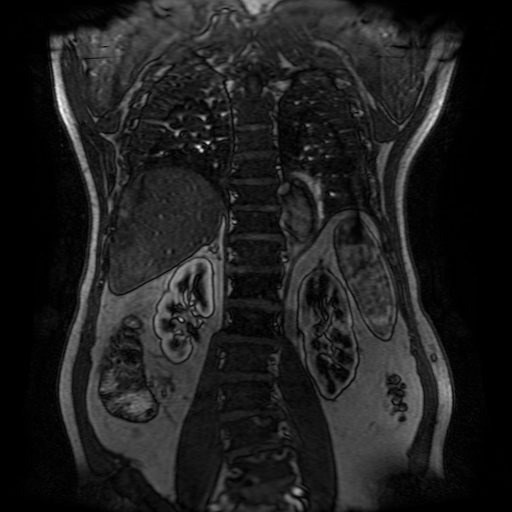 File:Aortic dissection - Stanford A - DeBakey I (Radiopaedia 23469-23551 D 182).jpg