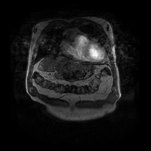 File:Aortic dissection - Stanford A - DeBakey I (Radiopaedia 23469-23551 D 29).jpg