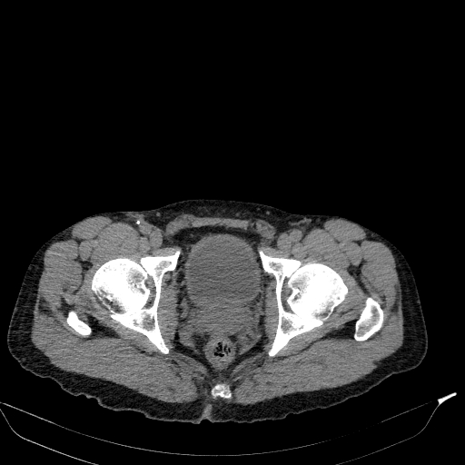 Aortic dissection - Stanford type A (Radiopaedia 83418-98500 Axial non-contrast 90).jpg