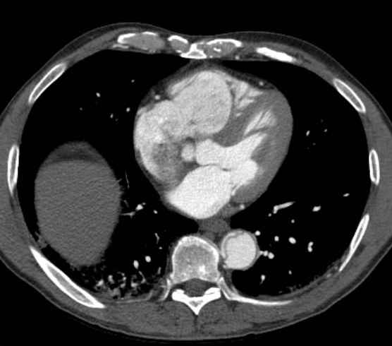 File:Aortic dissection - Stanford type B (Radiopaedia 73648-84437 A 74).jpg
