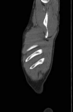 Aortic dissection - Stanford type B (Radiopaedia 73648-84437 C 156).jpg