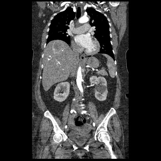File:Aortic dissection - Stanford type B (Radiopaedia 88281-104910 B 37).jpg