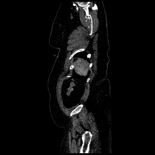 File:Aortic dissection - Stanford type B (Radiopaedia 88281-104910 C 79).jpg