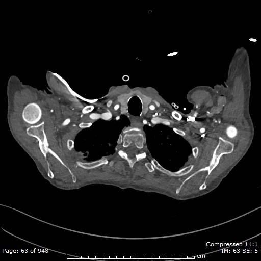 File:Aortic dissection with extension into aortic arch branches (Radiopaedia 64402-73204 B 63).jpg