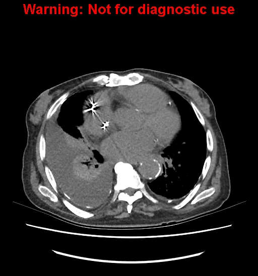 Aortic graft infection (Radiopaedia 44979-48907 Axial non-contrast 6).jpg