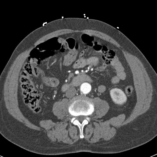 File:Aortic intramural hematoma (Radiopaedia 31139-31838 B 113).jpg