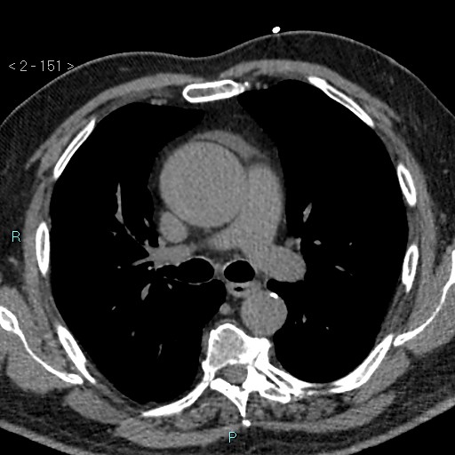 File:Aortic intramural hematoma (Radiopaedia 48463-53380 Axial non-contrast 67).jpg