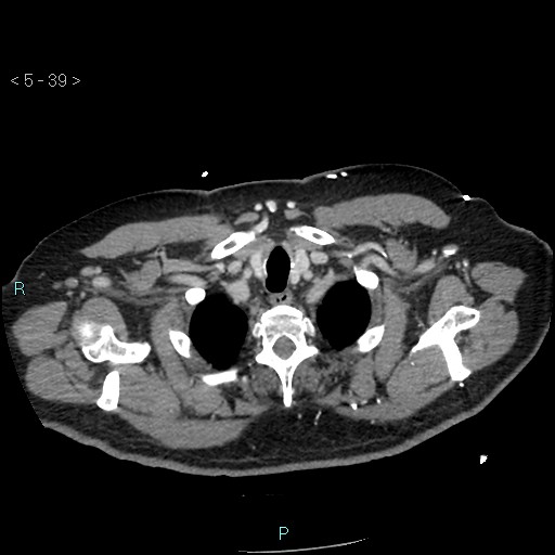 File:Aortic intramural hematoma (Radiopaedia 48463-53380 C 19).jpg