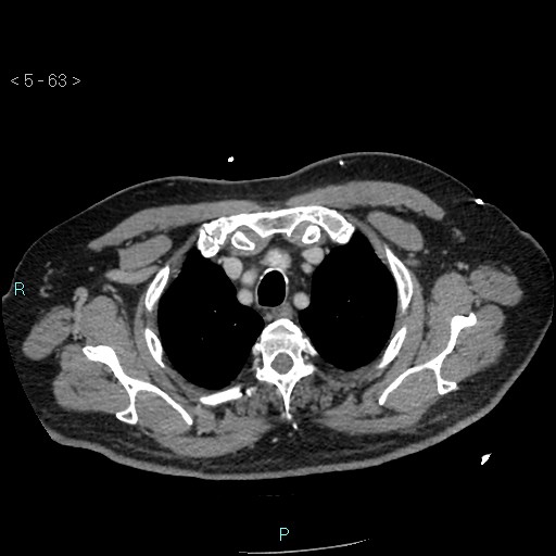 File:Aortic intramural hematoma (Radiopaedia 48463-53380 C 29).jpg