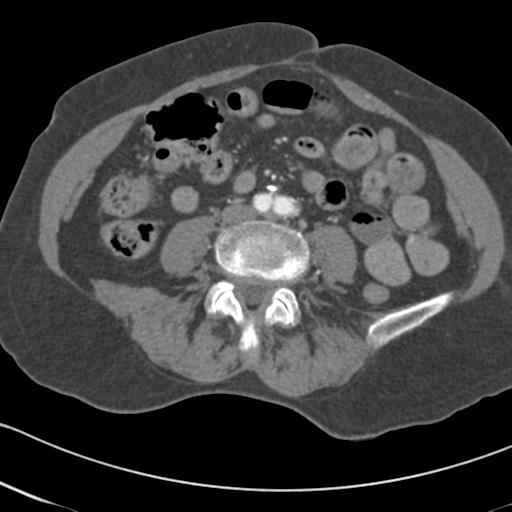 Aortic intramural hematoma from penetrating atherosclerotic ulcer (Radiopaedia 31137-31836 A 124).jpg