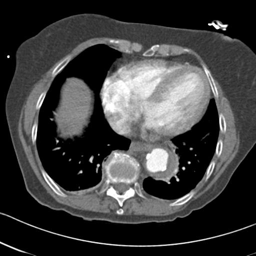 Aortic intramural hematoma from penetrating atherosclerotic ulcer (Radiopaedia 31137-31836 A 57).jpg