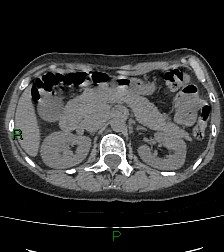 Aortic valve endocarditis (Radiopaedia 87209-103485 Axial non-contrast 105).jpg