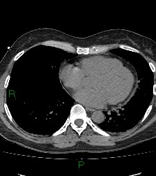 Aortic valve endocarditis (Radiopaedia 87209-103485 Axial non-contrast 66).jpg