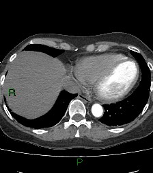Aortic valve endocarditis (Radiopaedia 87209-103485 C 73).jpg
