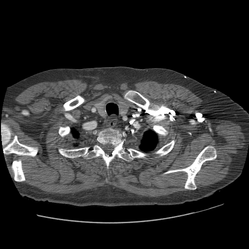 File:Aorto-coronary bypass graft aneurysms (Radiopaedia 40562-43157 A 14).png
