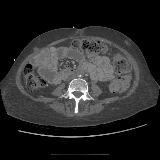 Aorto-duodenal fistula (Radiopaedia 25668-25850 A 46).jpg