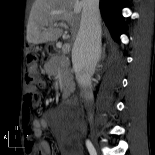 Aorto-left renal vein fistula (Radiopaedia 45534-49628 C 21).jpg