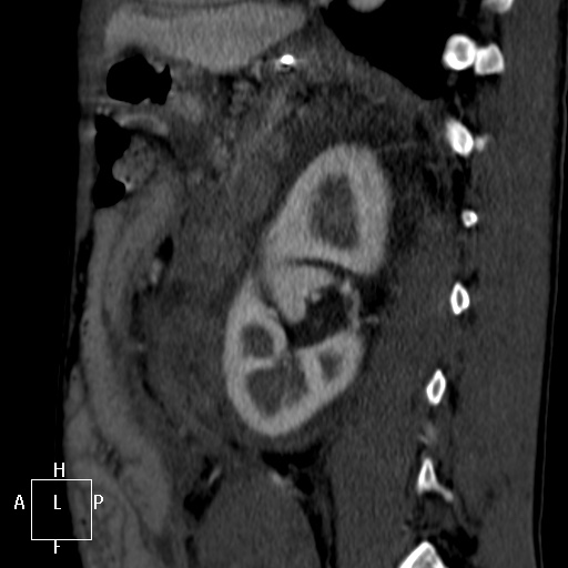Aorto-left renal vein fistula (Radiopaedia 45534-49628 C 48).jpg